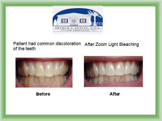 How Is Professional In-Office Teeth Bleaching Done