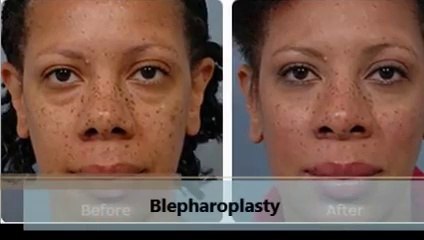 Center for Aesthetic Modernism Best Blepharoplasty in Chevy Chase