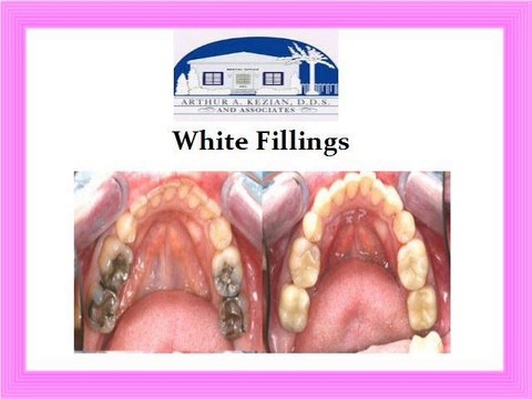 Different Types of Cosmetic Dentistry