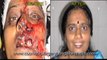 Cosmetic surgery Bangalore India Facial Injuries Before and After