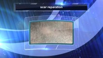 scar reparation