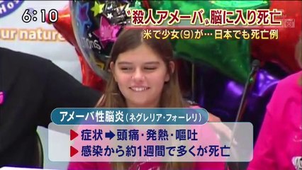 14 07 17 EX SJC　殺人アメーバ　アメーバ性脳炎