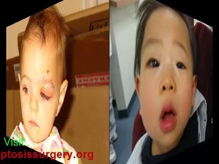 Ptosis Surgery Recovery