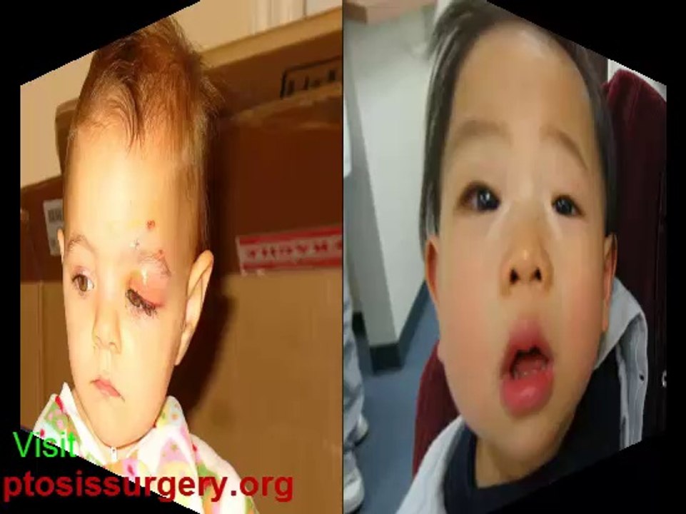 Ptosis Surgery Recovery