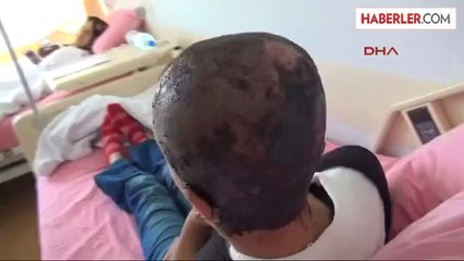 Küçük Merve'nin Kafa Derisi 12 Saatte Yerine Dikildi