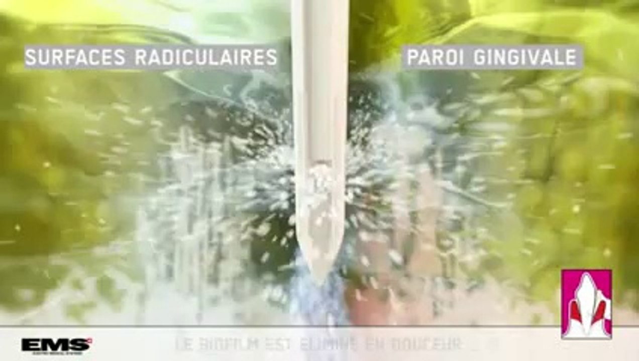 Traitement dentaire avec la Méthode AIR-FLOW® Perio