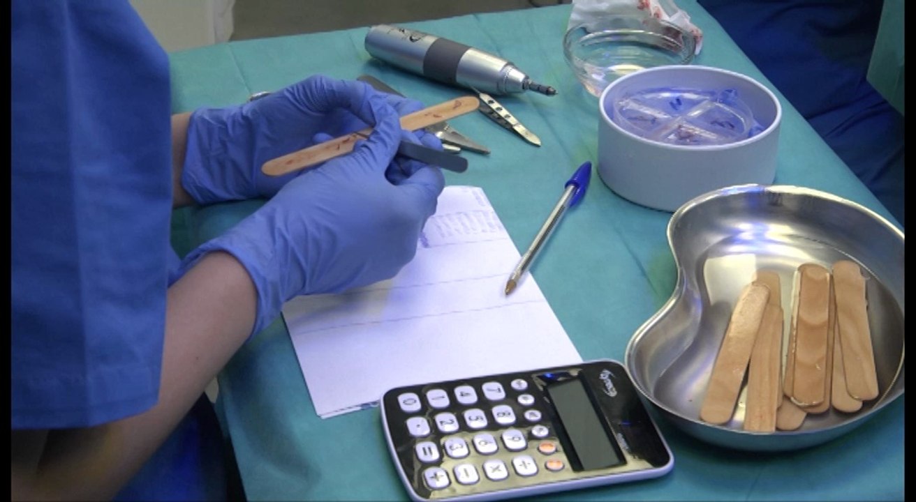 Trasplante de pelo. Trasplante capilar. FUE Bilbao. Dermitek