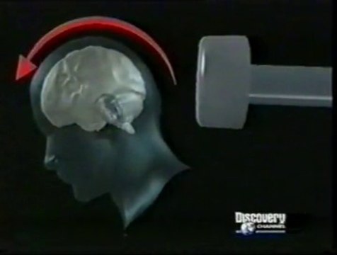 TCE: Efectos fisiologicos (Edema e hipoxia)