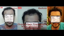 hairline design by FUE hair transplant in Pakistan, Laser Hair Transplant Pakistan