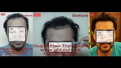 hairline design by FUE hair transplant in Pakistan, Laser Hair Transplant Pakistan
