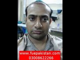 FUE hair transplant in Gujrat Pakistan , Laser Hair Transplant pakistan