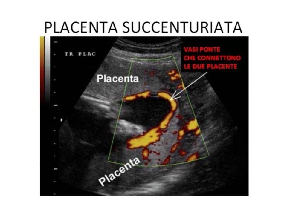 9 Placenta succenturiata
