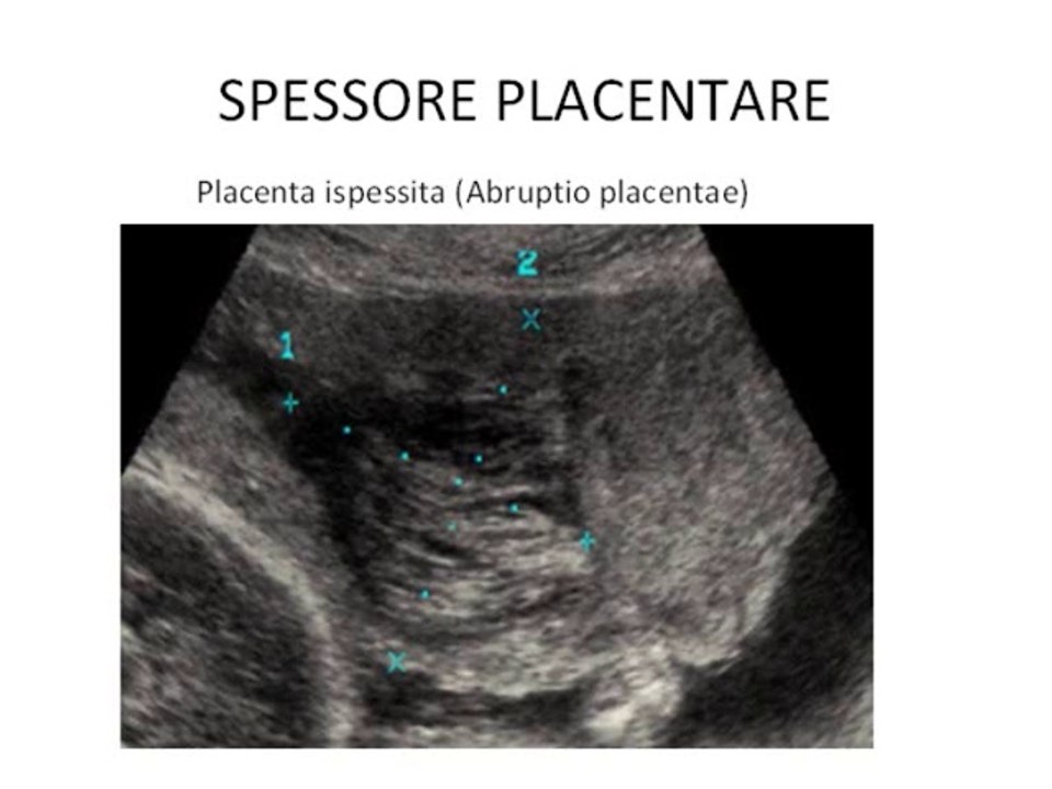 Spessore placentare