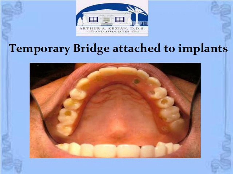 Dental Implant Case Types