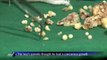 Surgeons remove 232 teeth from Indian teenager