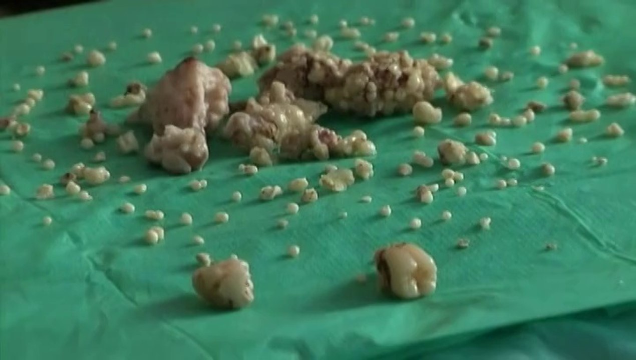 Les chirurgiens extraient 232 dents de la bouche d'un Indien de 17 ans