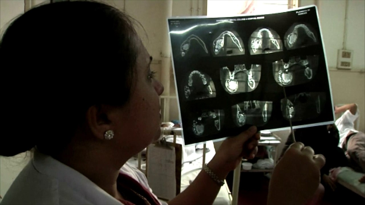 Un jeune Indien avait 232 dents en trop