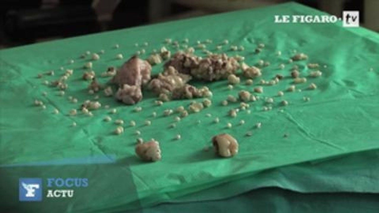 En Inde, un ado se fait enlever 232 dents