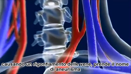 Come il Colesterolo Chiude le Arterie