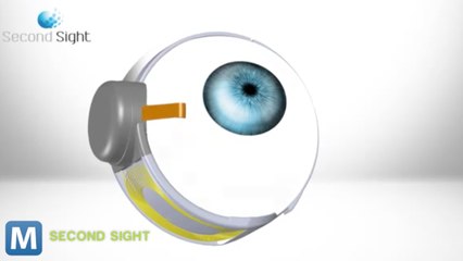 First Bionic Eye Being Used in the U.S.