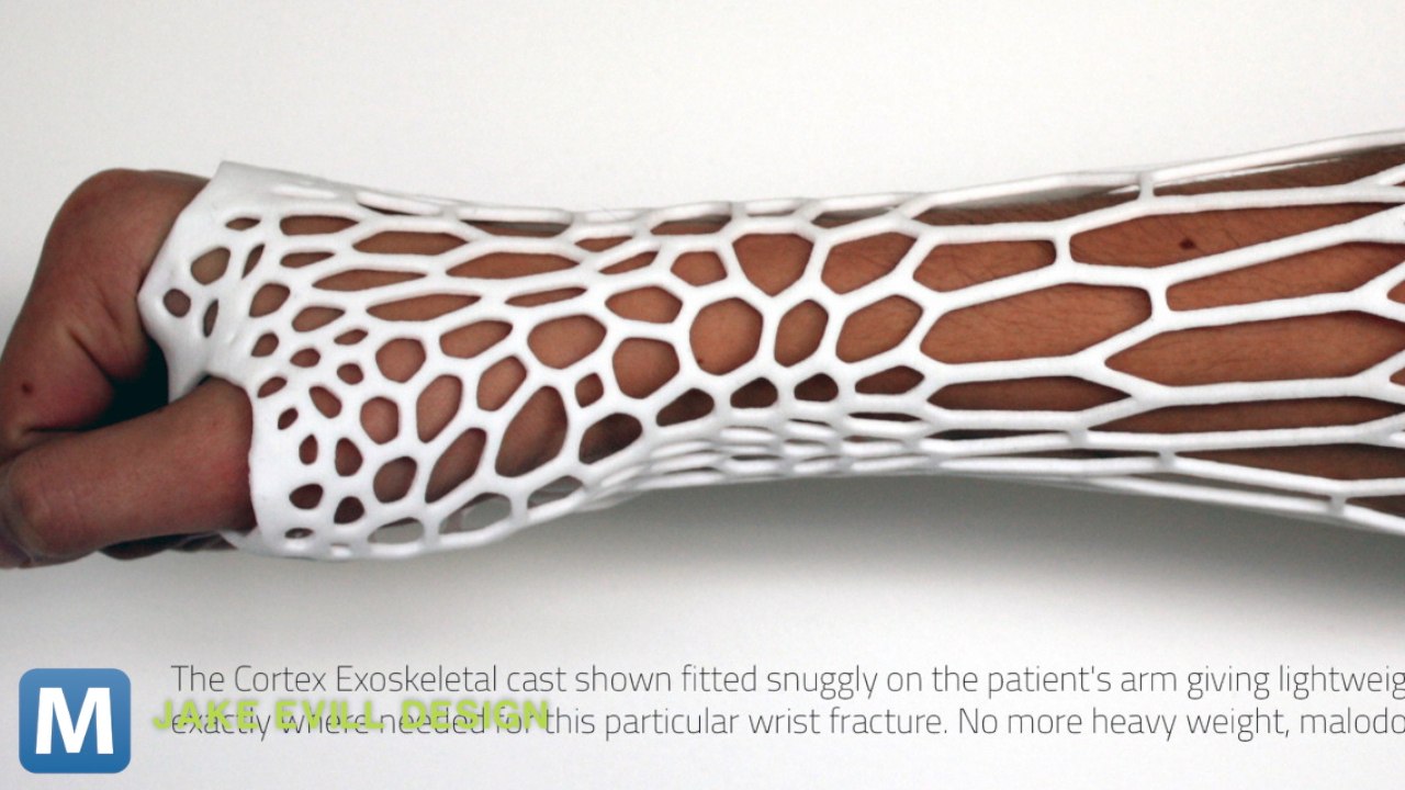 Modernizing the Plaster Cast with a 3D Printer