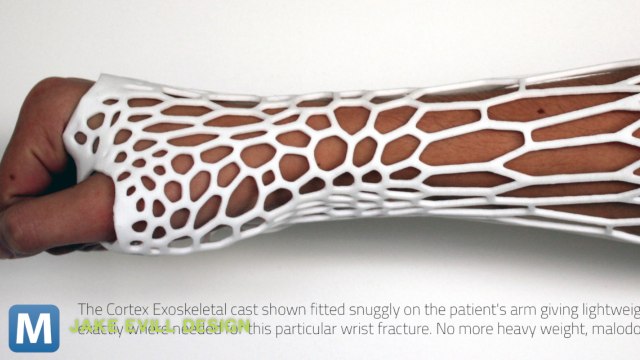 Modernizing the Plaster Cast with a 3D Printer