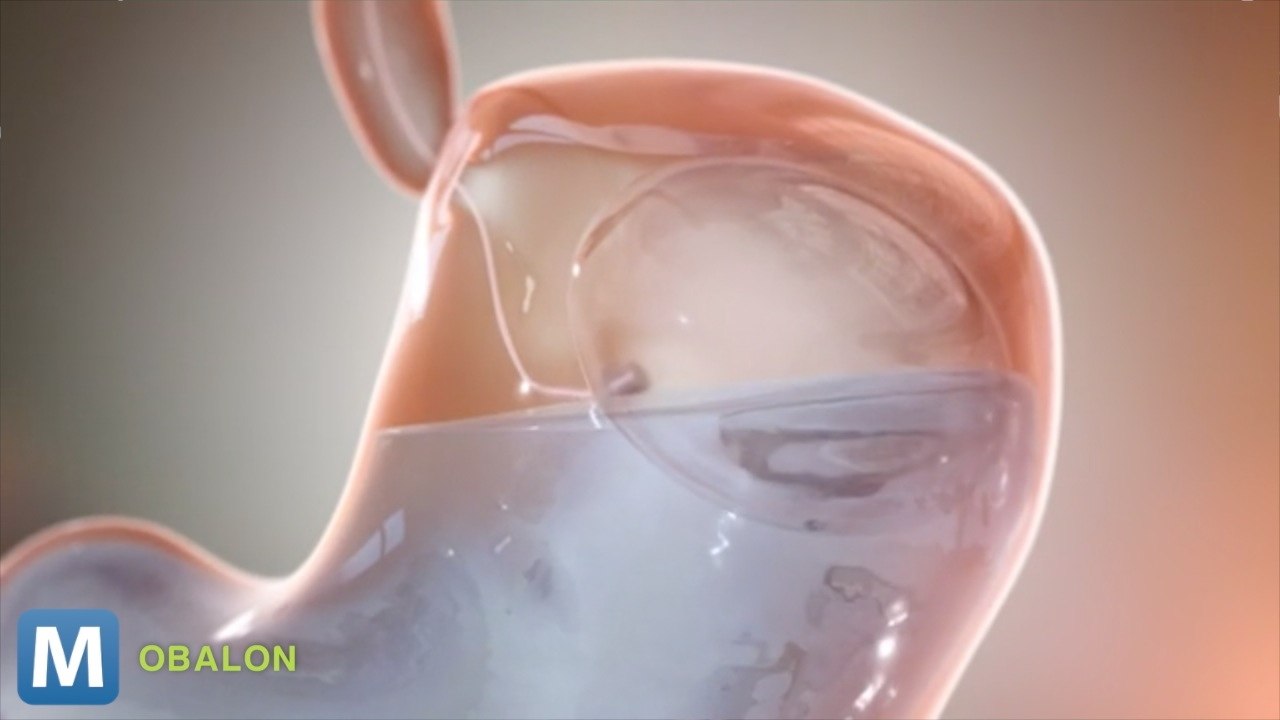 Weight Loss, Gastric ‘Balloon’ Marketed in Europe