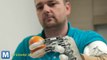 Bionic Hand Gives Patient Ability to Feel Objects Again