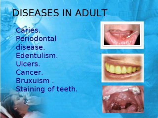 Oral Hygine And Dental Care