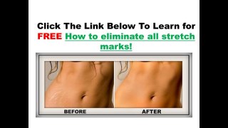 how to get rid of stretch marks tip 2