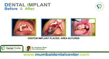 Dental Clinic in Navi Mumbai-Dental implants in Ghatkopar | Dentists in Ghatkopar | Dental Clinic in Ghatkopar