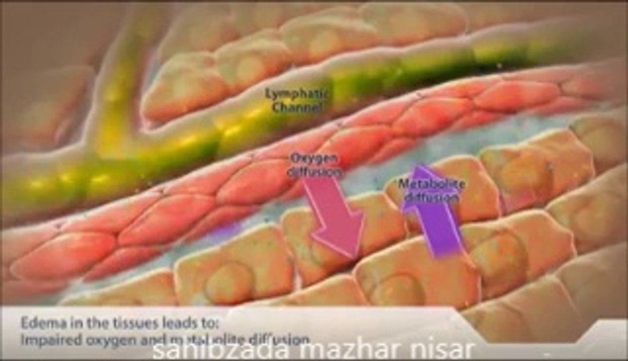 fluid overload on tissues