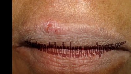 Agora Como Curar Herpes Em Portugues