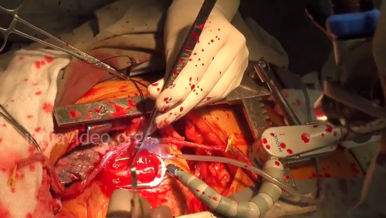 Open Heart Surgery