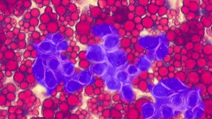 Obésité et complications