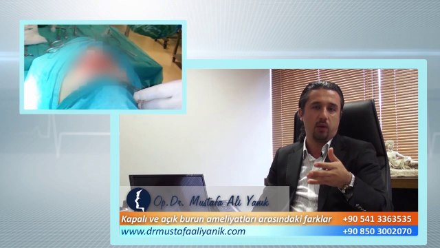 Op. Dr. Mustafa Ali Yanık açık teknik ve kapalı teknik burun estetiği operasyonları arasındaki farklar nelerdir