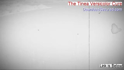The Tinea Versicolor Cure Review - Hear my Review (2014)