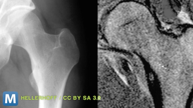 Ultrasound Surgery Melts Away Tumors, no Incisions Required