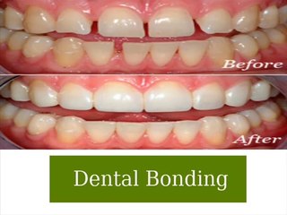 Types of cosmetic dentistry