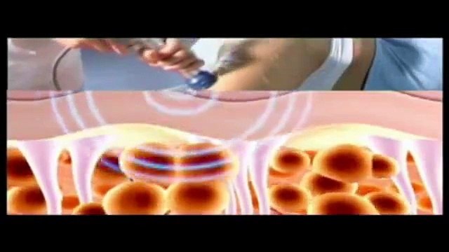 Selülit Tedavisi - Fragman