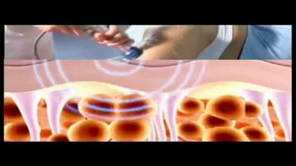 Selülit Tedavisi - Fragman