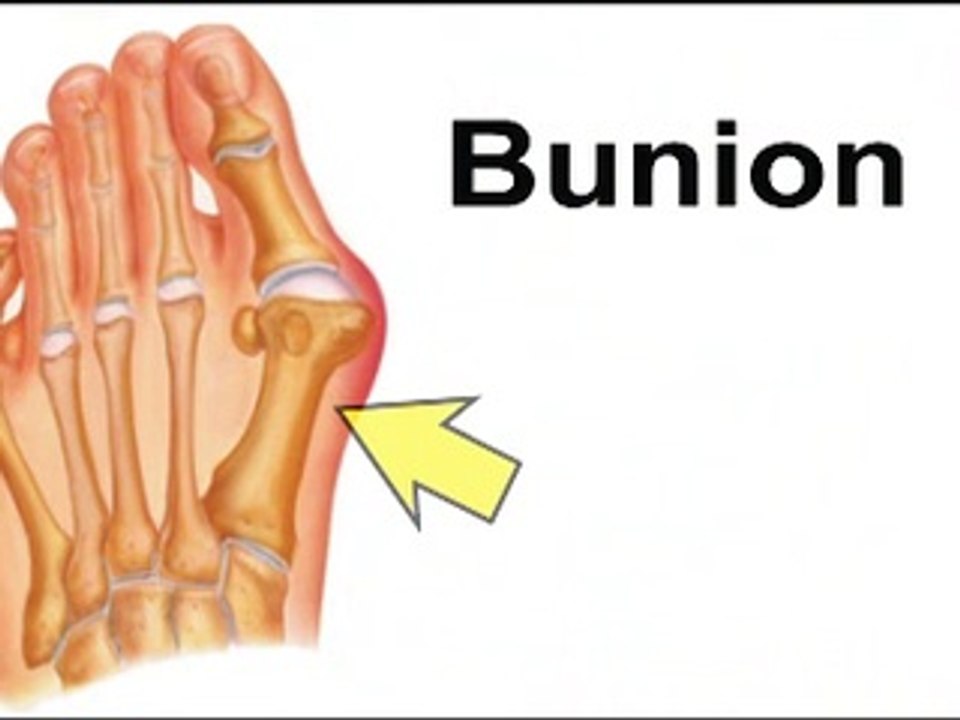 Fort Worth and Arlington, TX - Podiatrist Glen Beede - Bunions