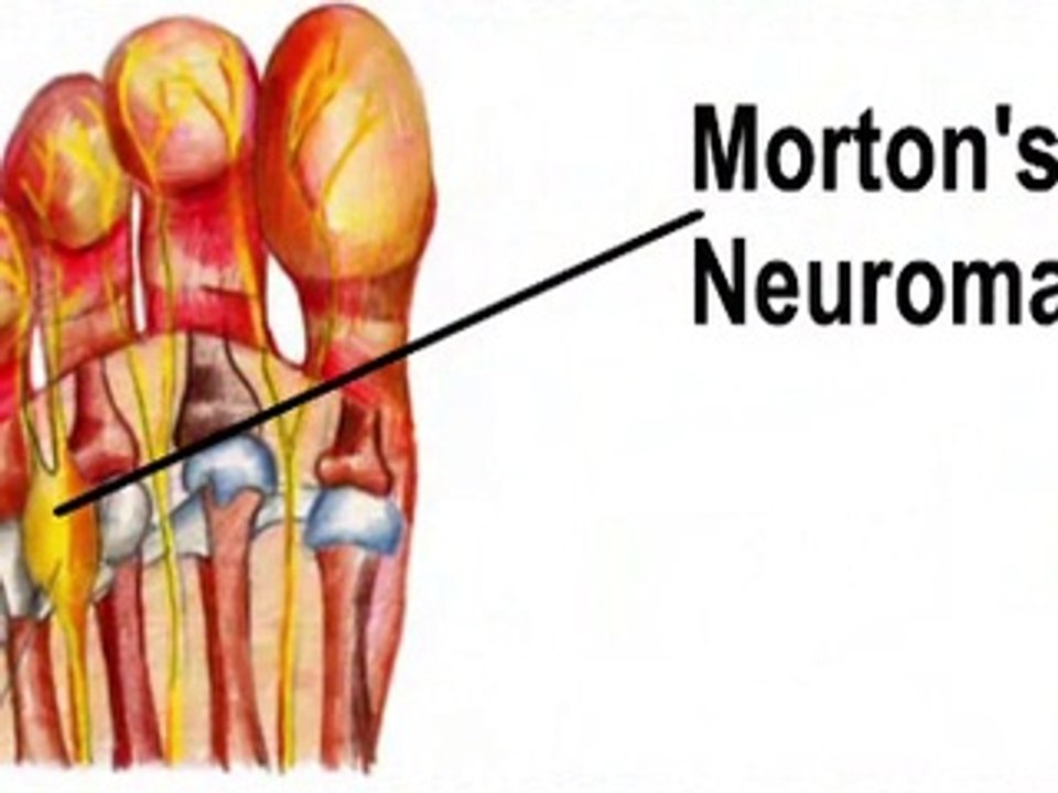 Fort Worth and Arlington, TX - Morton’s Neuroma - Podiatrist Glen Beede, DPM