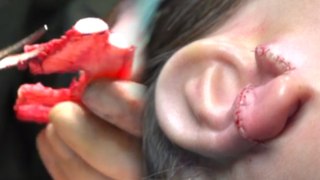 Boy Gets New Ears Made from His Ribs