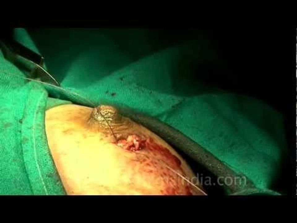 Stitching the incision to stop blood loss...