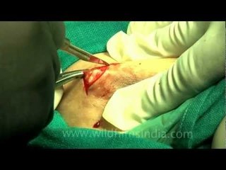 Cutting around the nipples during surgery