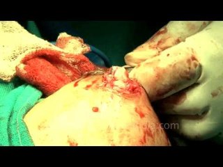 Blood soaked gloves during the surgery...