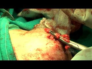 Stitching the incision after the surgery