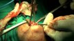 Blood filled surgery - The breast cancer surgery..
