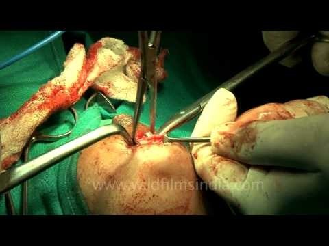 Blood filled surgery - The breast cancer surgery..
